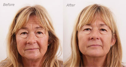 Fontana Estetic, Elixis Elite Face-lifting
