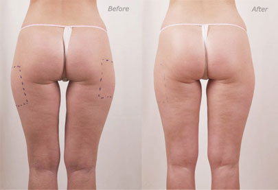 Fontana Estetic, Elixis Elite Legs